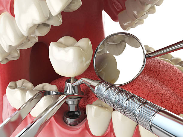 Best Emergency Dentist for Lost Fillings or Crowns in Santa Cruz, CA